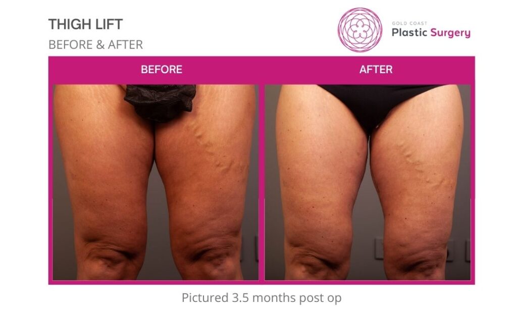 thigh lift before after