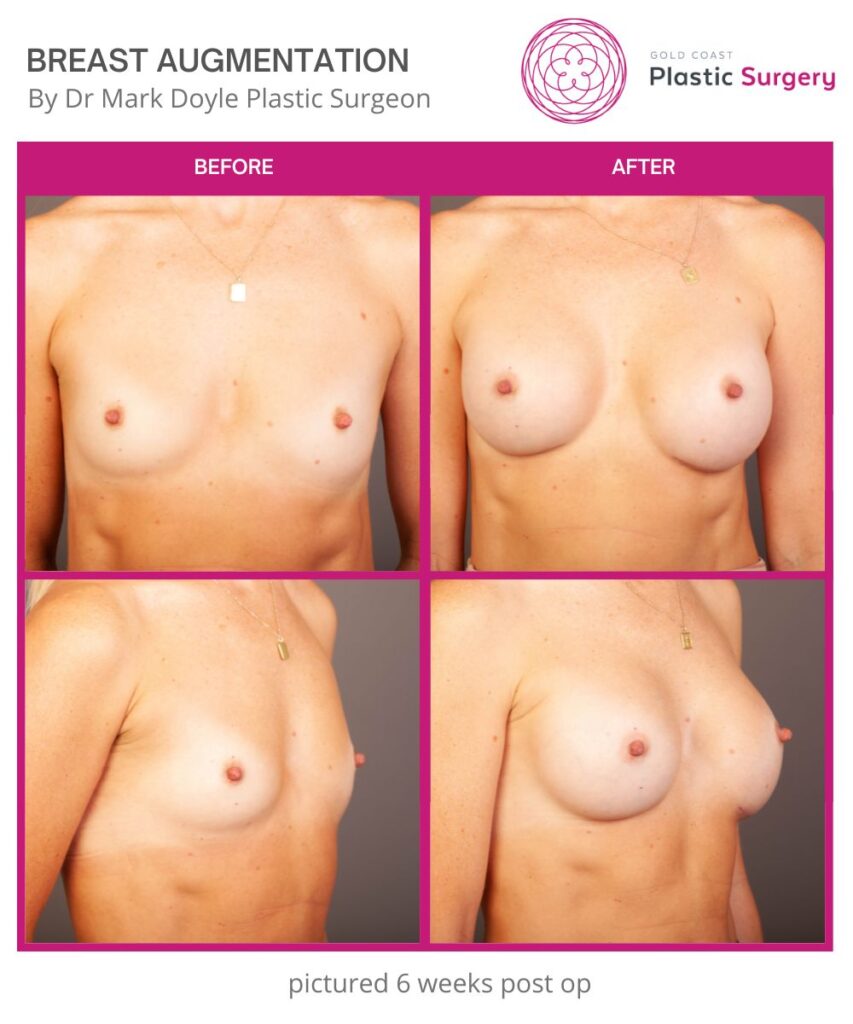 boob job breast augmentation before and after images