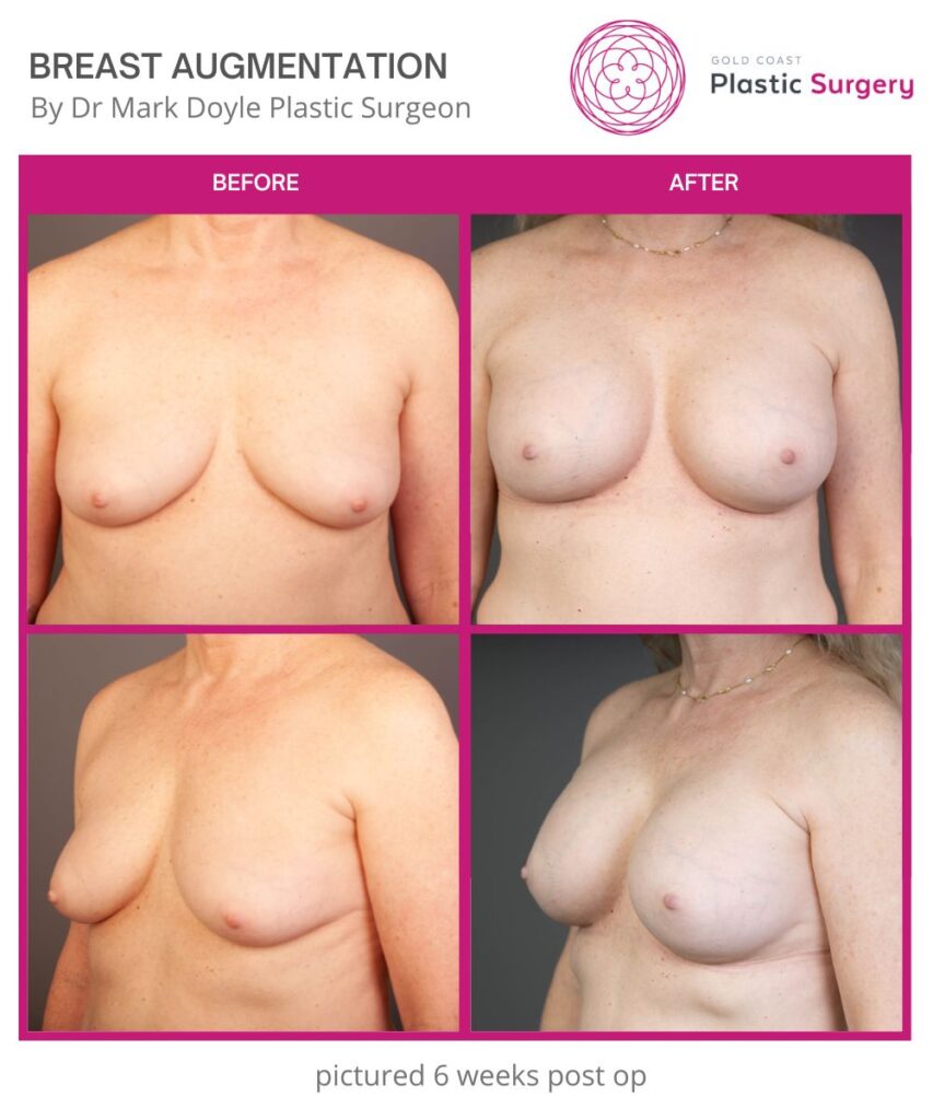 boob job breast augmentation before and after images