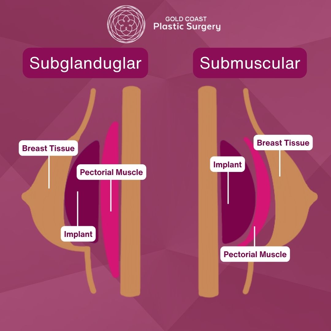 Breast implant placement above below muscle