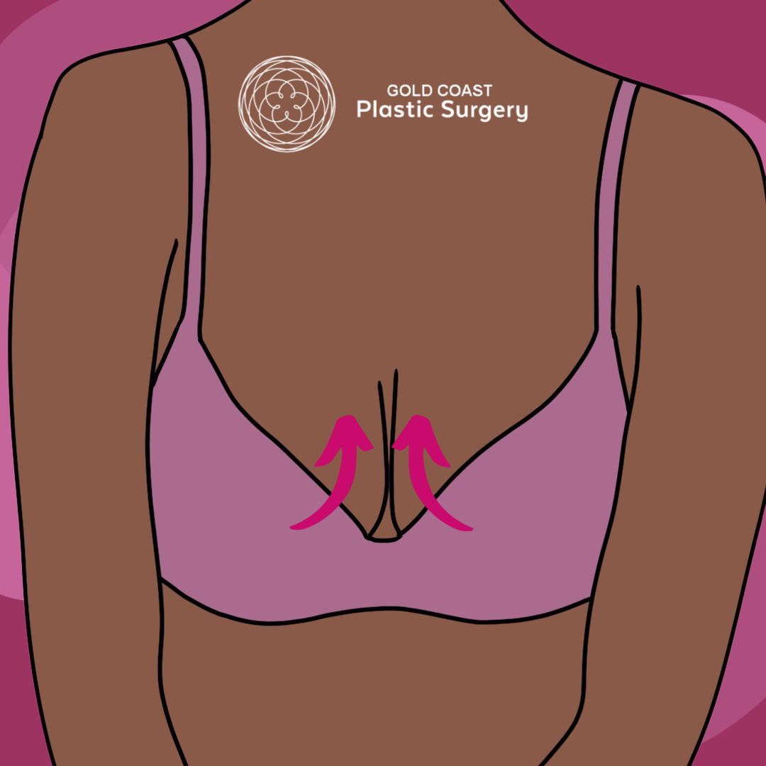 hybrid boob job procedure gold coast queensland