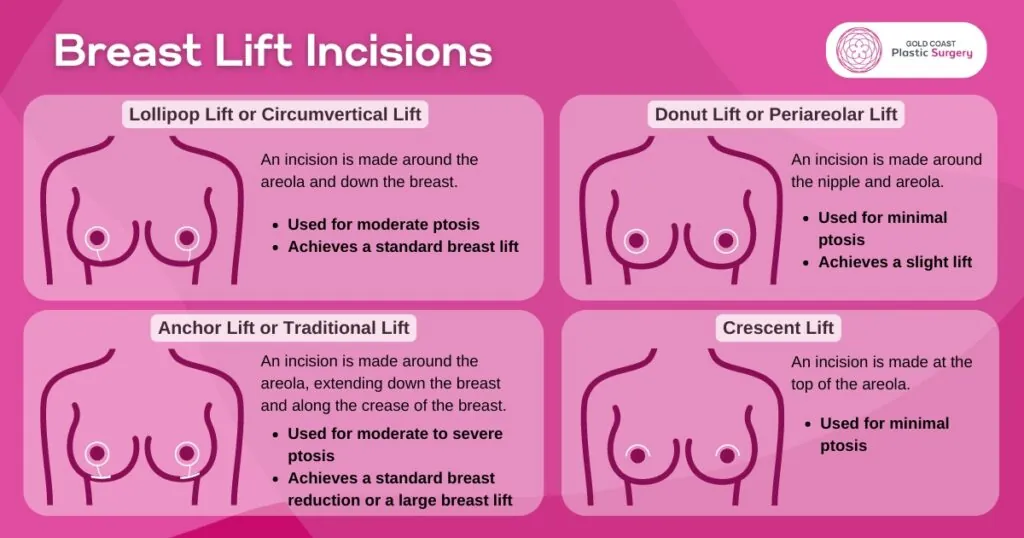 anchor breast lift procedure cosmetic surgery brisbane