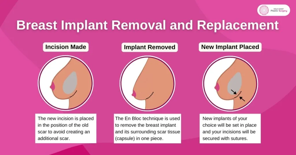 best new breast lift techniques for sagging breasts nsw