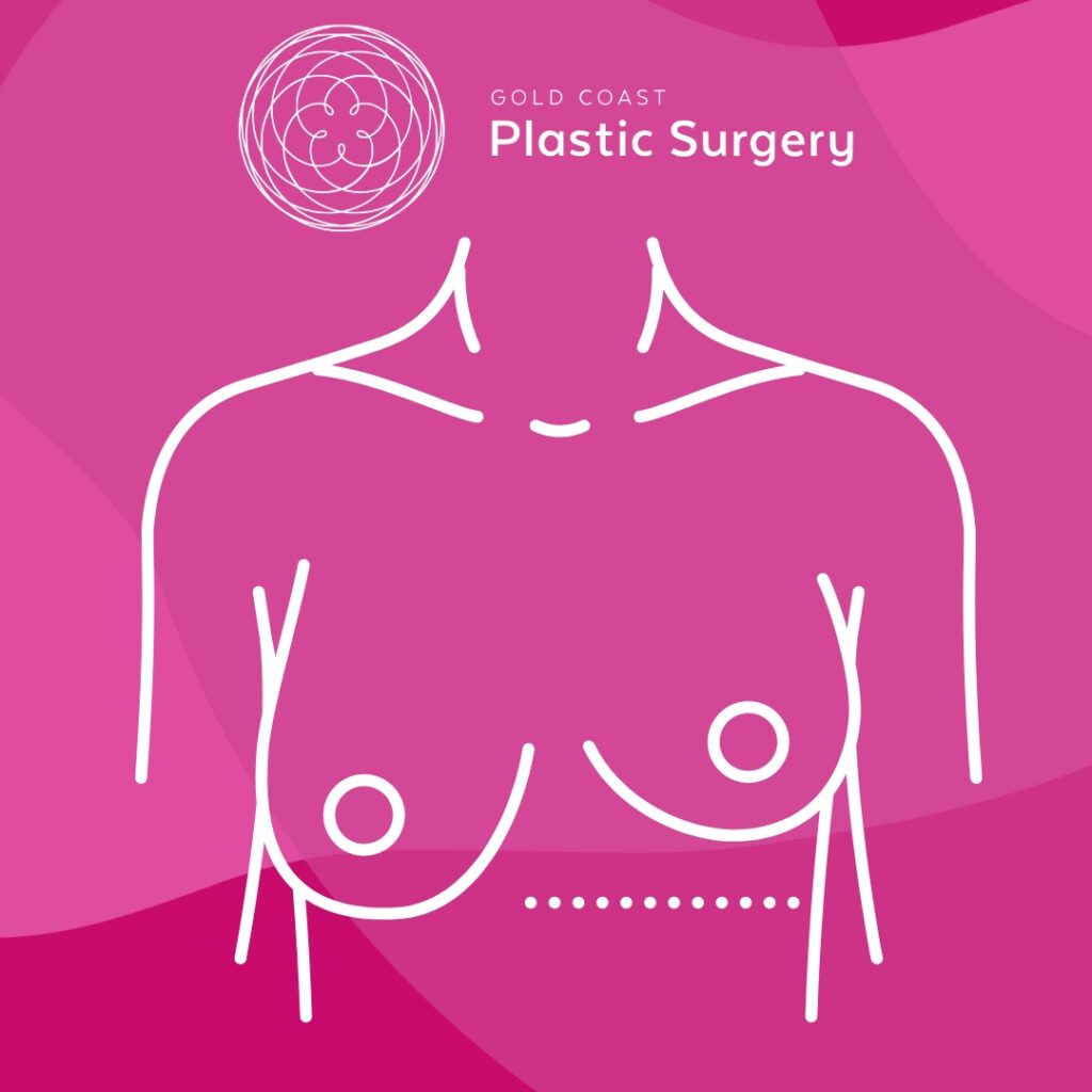 breast asymmetry surgery queensland