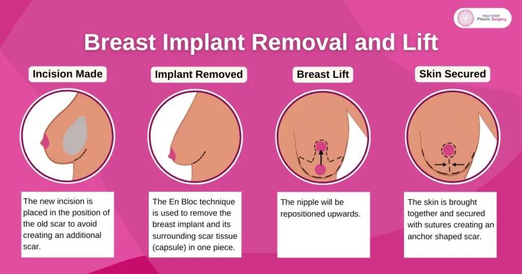 breast implant removal and lift 