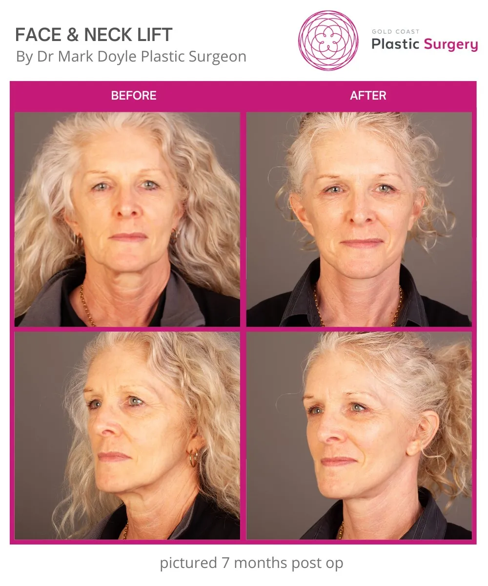 facelift before and after 50 year old