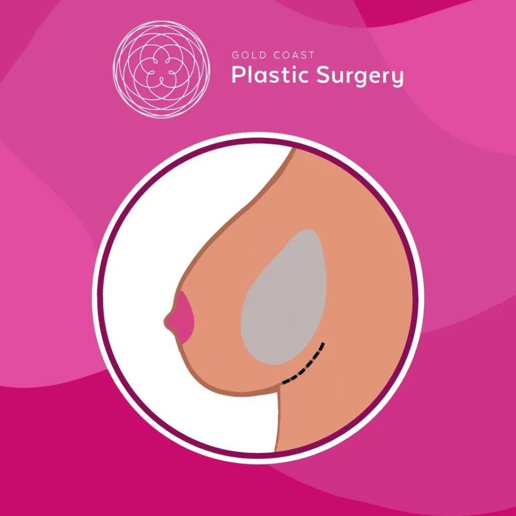 hybrid breast augmentation procedure gold coast queensland