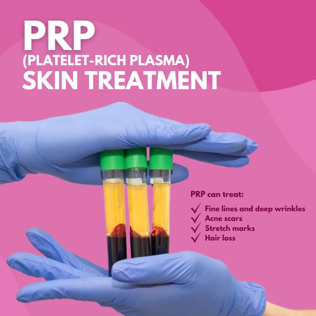 Best PRP Platelet-Rich Plasma skin microneedling and PRP hair treatment Gold Coast, QLD and Tweed, Northern NSW $350. 