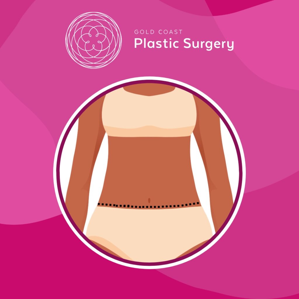 what is abdominoplasty tummy surgery