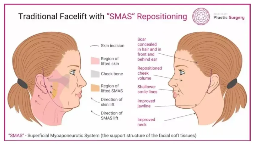 SMAS Face Lift gold coast