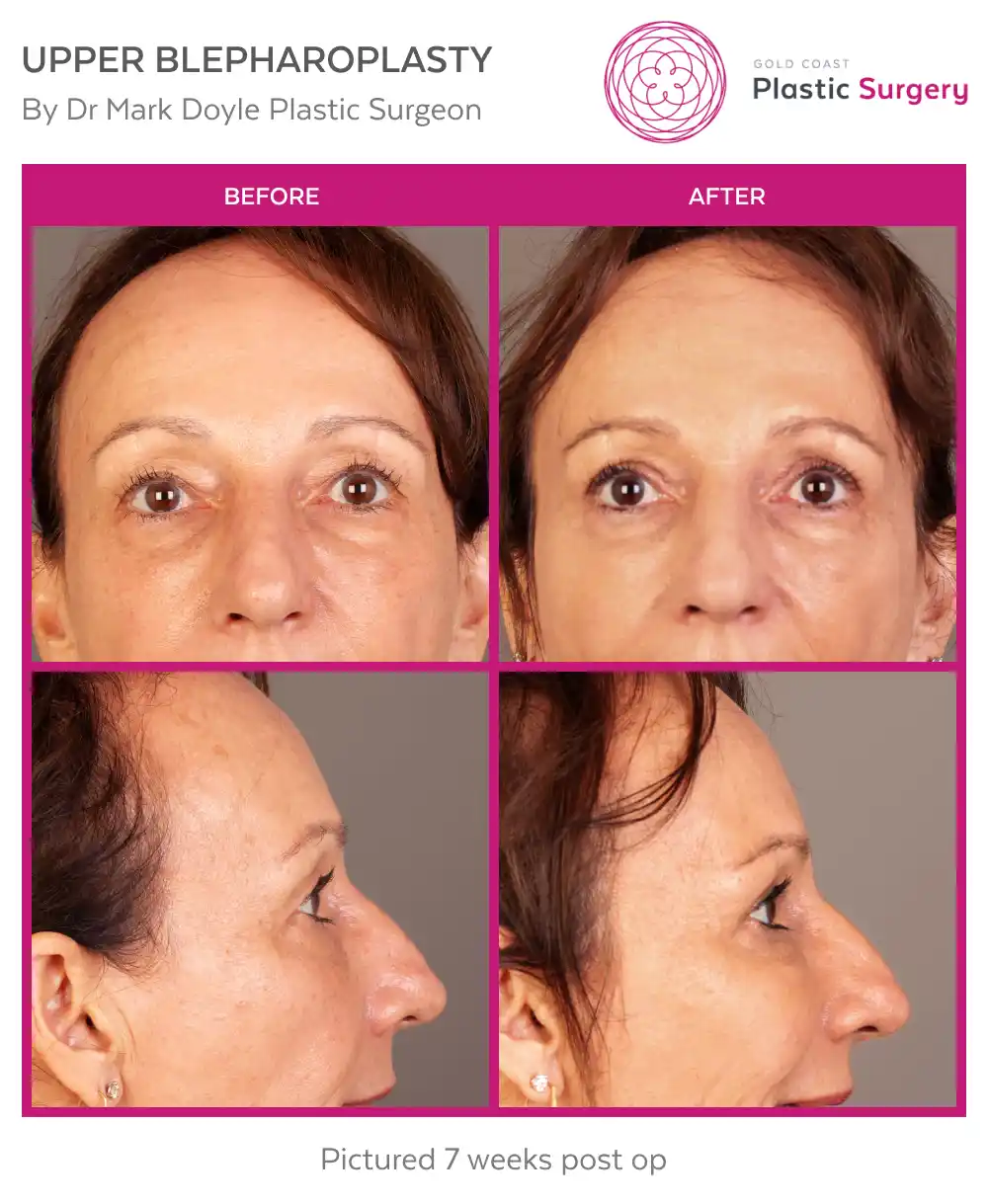 GCPS-DrMarkDoyle-Upper-Blepharoplasty-Monika