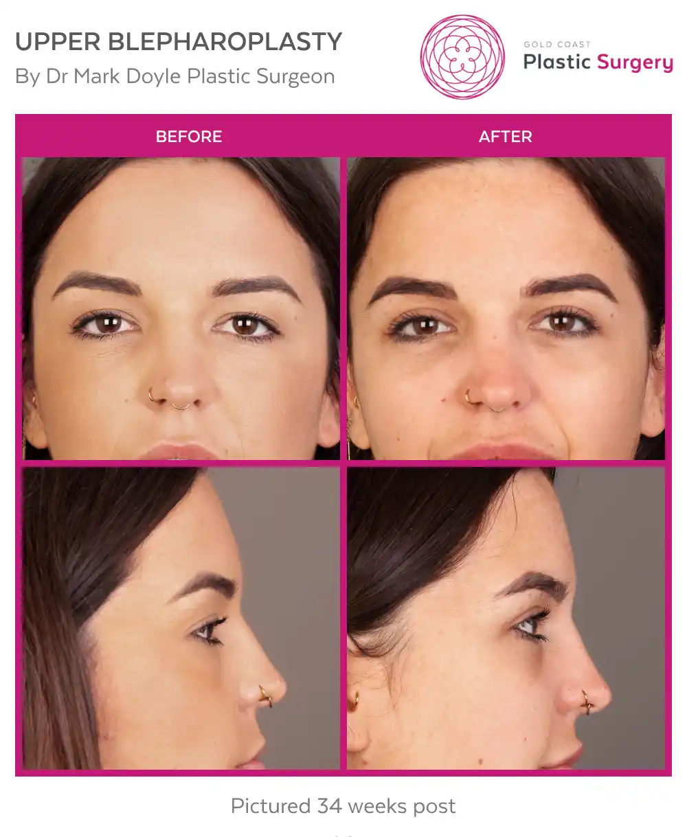 GCPS-DrMarkDoyle-Upper-Blepharoplasty-Emma